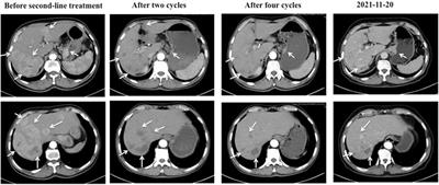 Case report: Long-term partial response of apatinib plus paclitaxel as second-line therapy in a patient with metastatic gastric cancer